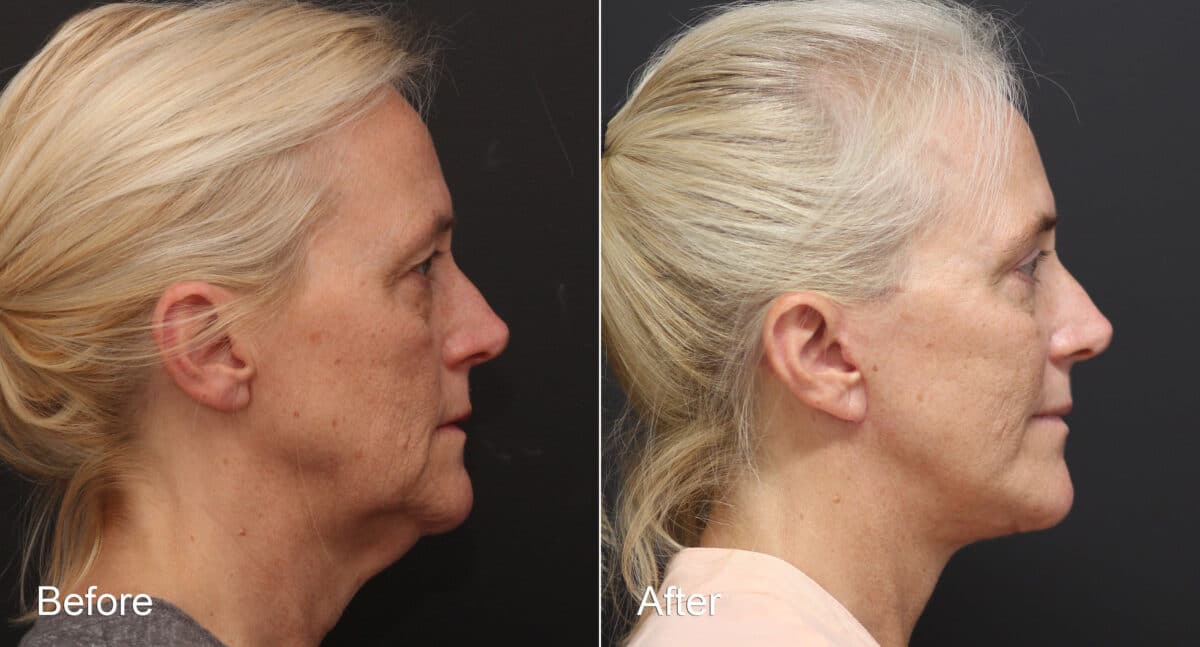 Neck Lift Before and After Photos in Princeton, NJ, Patient 8763