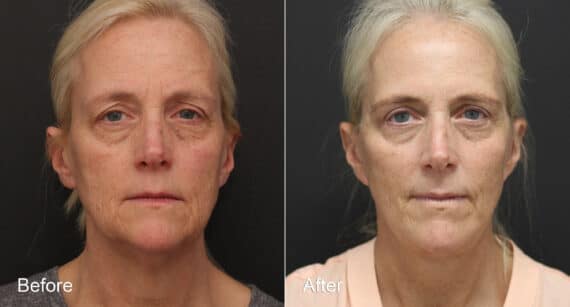 Neck Lift Before and After Photos in Princeton, NJ, Patient 8763