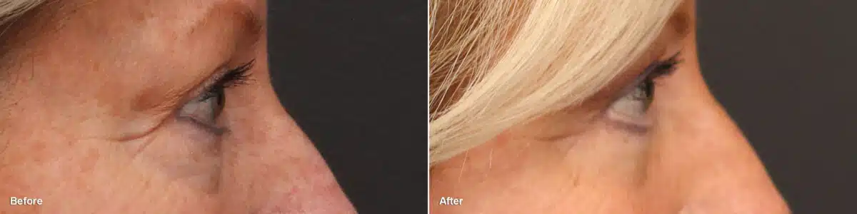 Lower Eyelid Surgery Before and After Photos in Princeton, NJ, Patient 8847