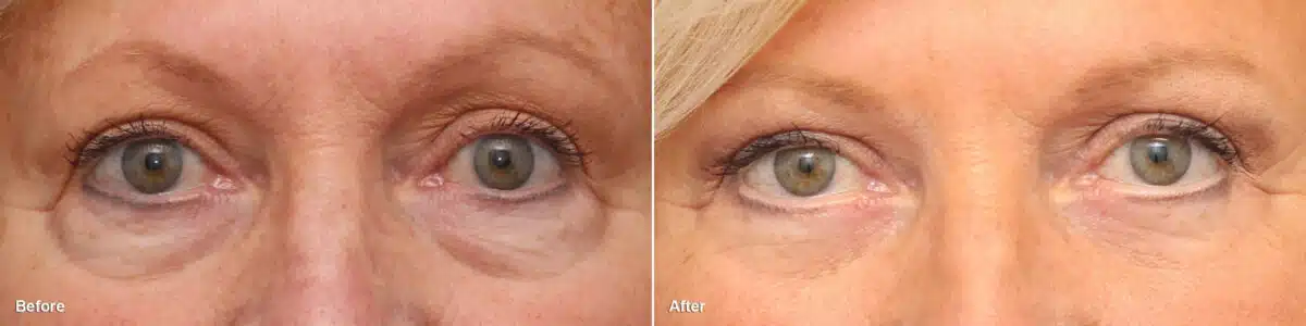 Lower Eyelid Surgery Before and After Photos in Princeton, NJ, Patient 8847