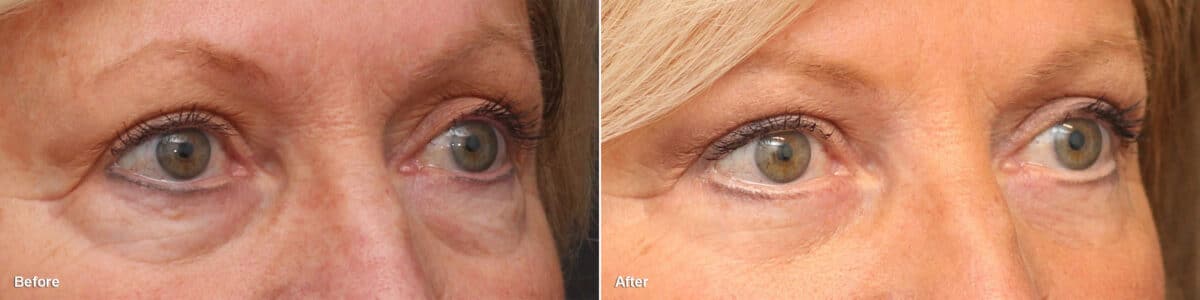 Lower Eyelid Surgery Before and After Photos in Princeton, NJ, Patient 8847