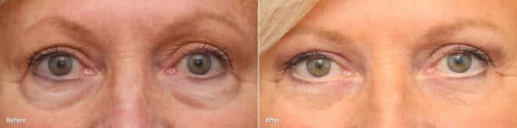 Lower Eyelid Surgery Before and After Photos in Princeton, NJ