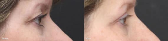 Upper Eyelid Surgery Before and After Photos in Princeton, NJ, Patient 8857