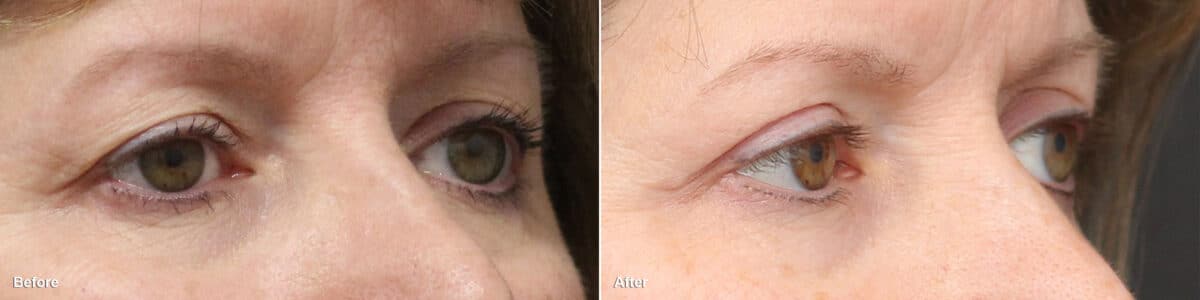 Upper Eyelid Surgery Before and After Photos in Princeton, NJ, Patient 8857