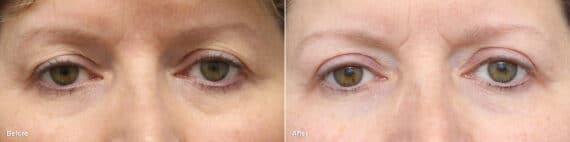 Upper Eyelid Surgery Before and After Photos in Princeton, NJ, Patient 8857