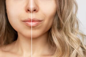 an image of a woman whose left side of her face shows the before and right side shows the after of a buccal fat removal procedure.