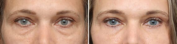 Upper Eyelid Surgery Before and After Photos in Princeton, NJ, Patient 10896