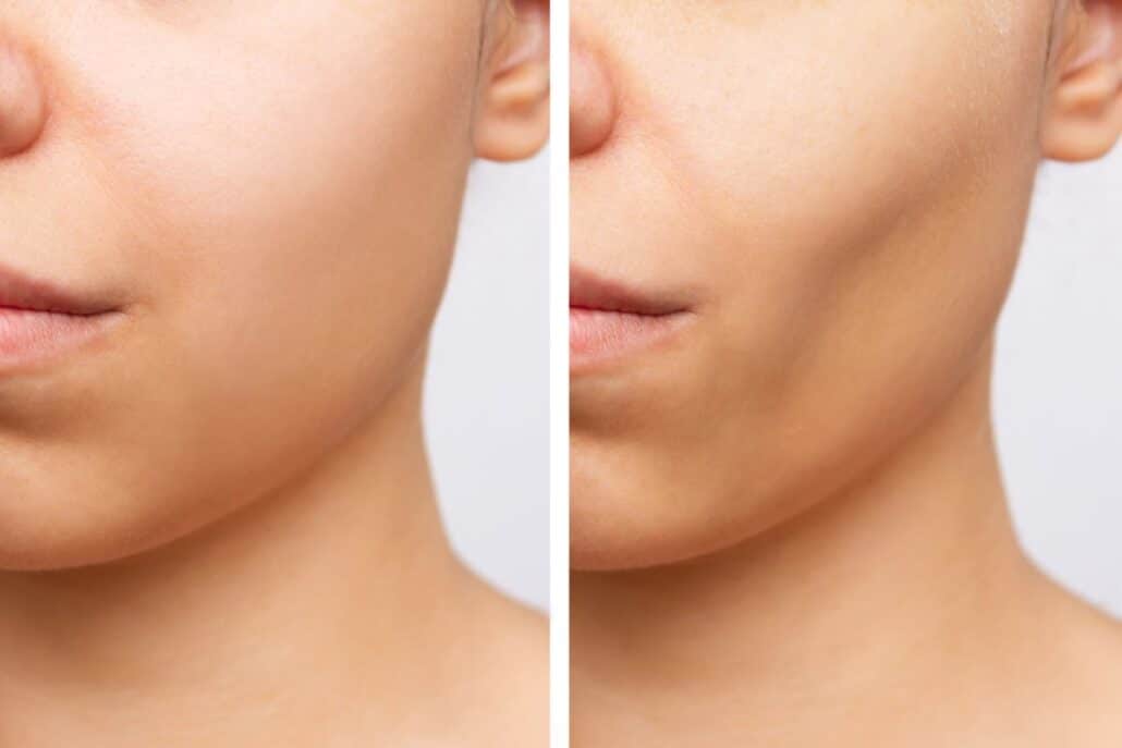 Before and after comparison showing defined facial aesthetics post buccal fat removal.