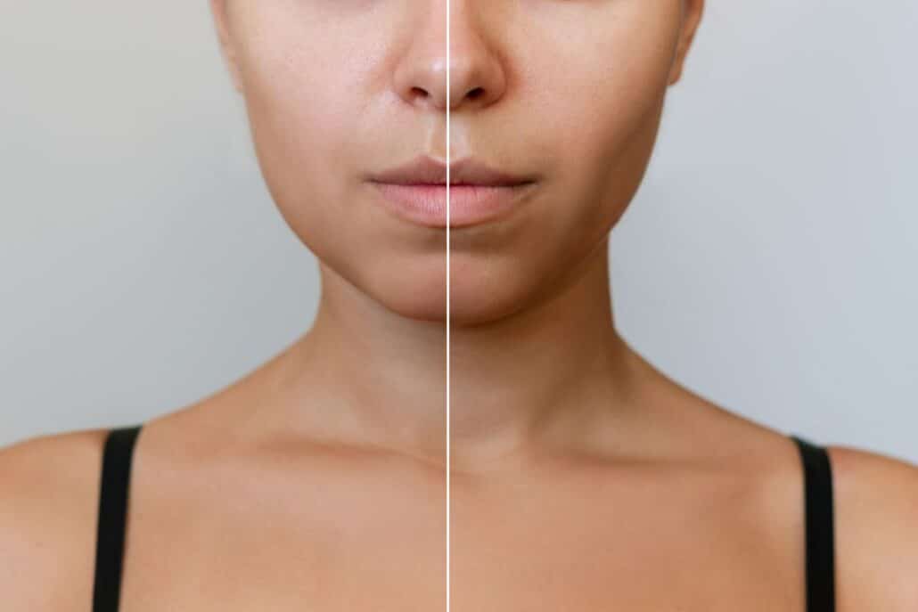 Before and after visuals of enhanced cheek hollows from buccal fat removal.