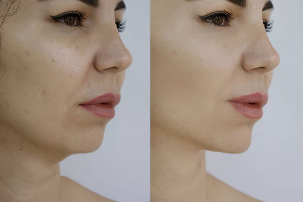 Lower view of a facelift patient's face before and months after surgery.