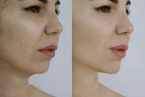Lower view of a facelift patient's face before and months after surgery.