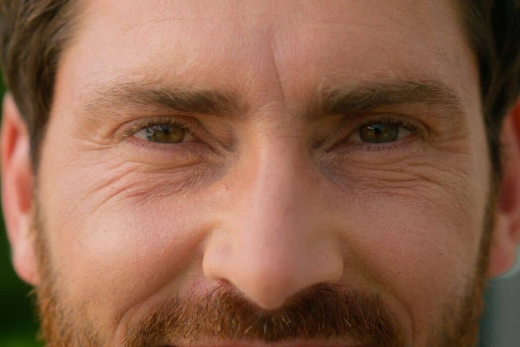 Close-up of man with visible forehead lines and crow’s feet, highlighting common Botox treatment areas for men