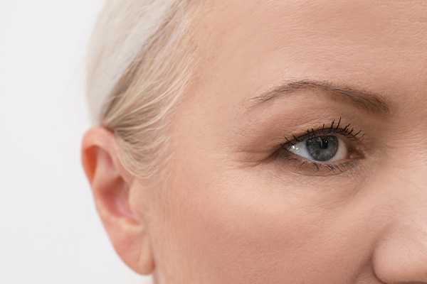 Close-up of eye area with fine lines showing Botox treatment for crow’s feet and smoother skin.