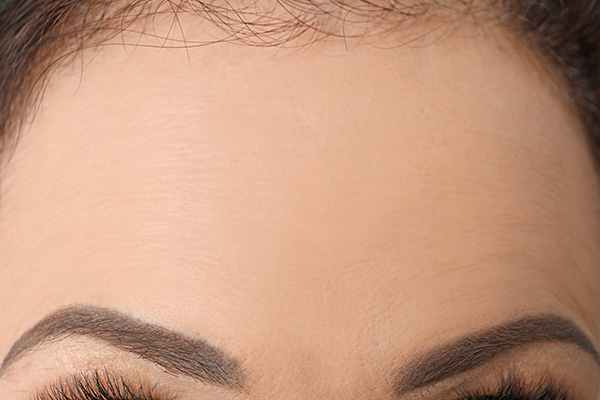 Close-up of forehead lines from raised brows highlighting Botox treatment area for smoother skin.