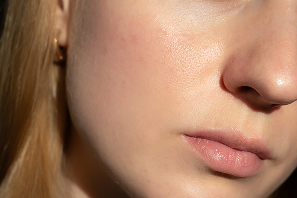Defined cheeks with reduced fullness after cheek fat removal, enhancing facial balance and contour.