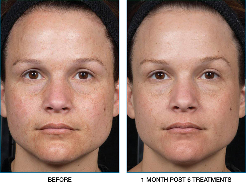 clear-brilliant-before-after-01