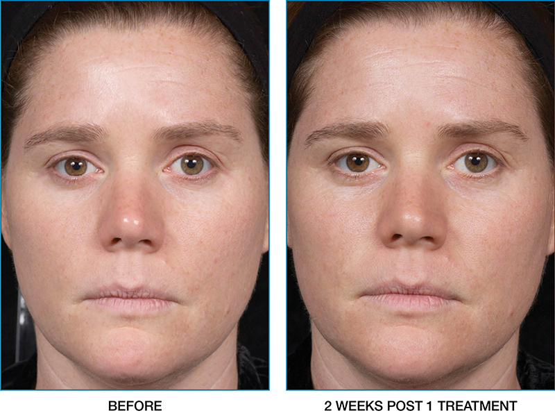 clear-brilliant-before-after-02
