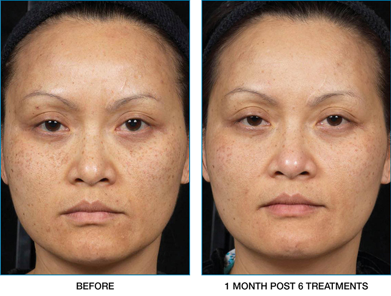 clear-brilliant-before-after-03