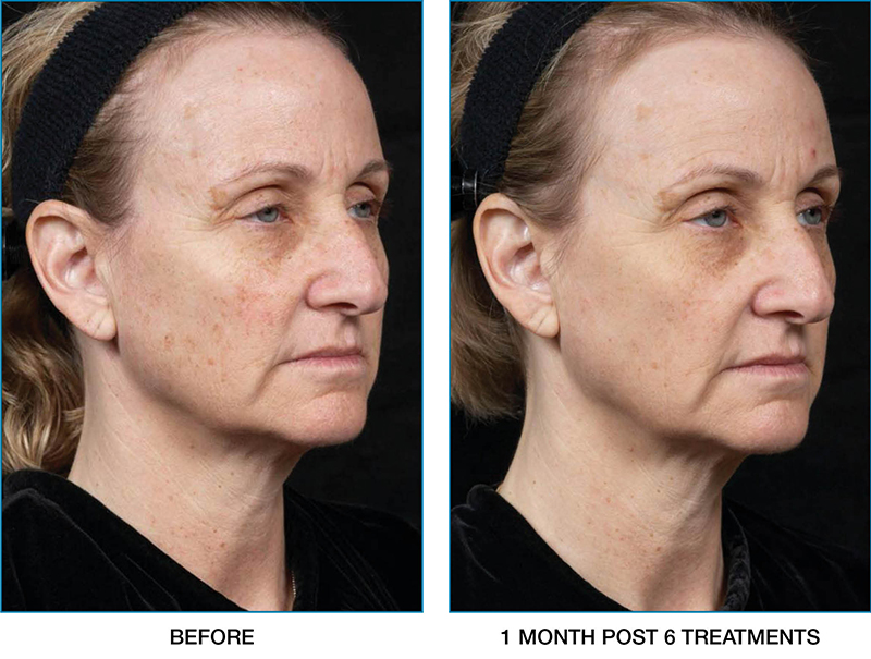clear-brilliant-before-after-04