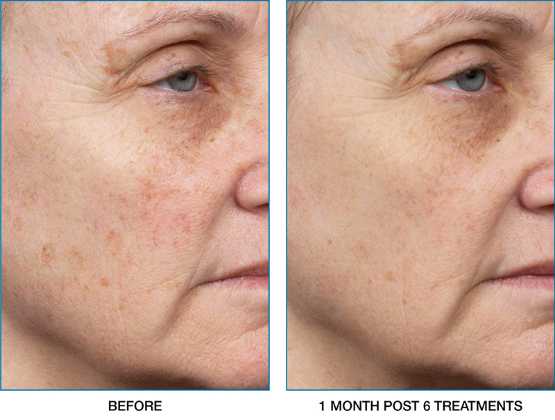 clear-brilliant-before-after-05
