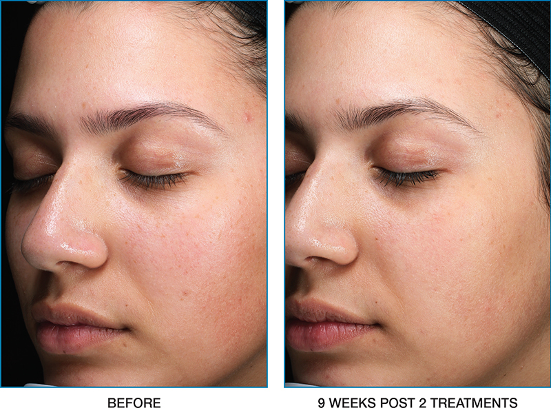 clear-brilliant-before-after-06