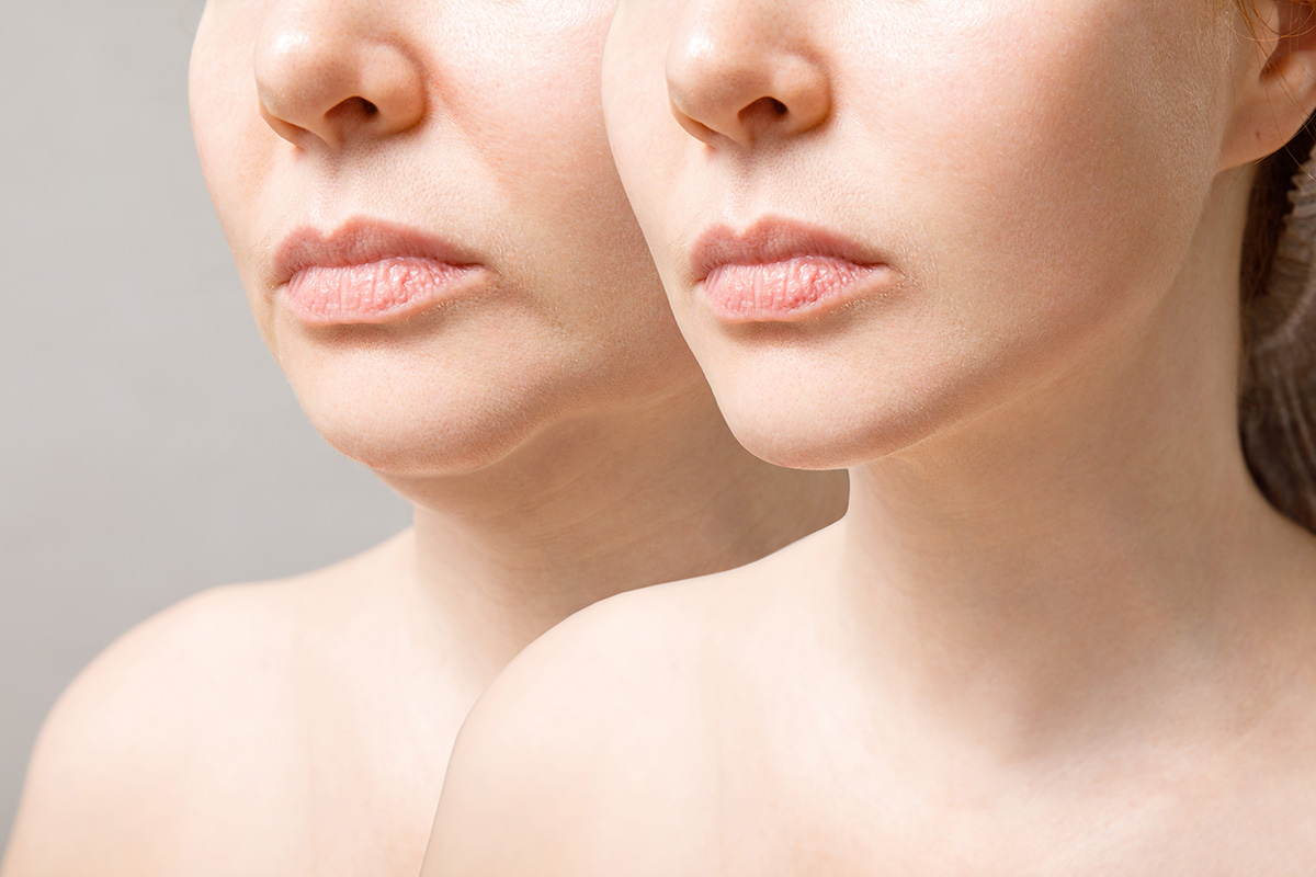 Before and after view of jawline showing improved contour and reduced fat after facial liposuction.