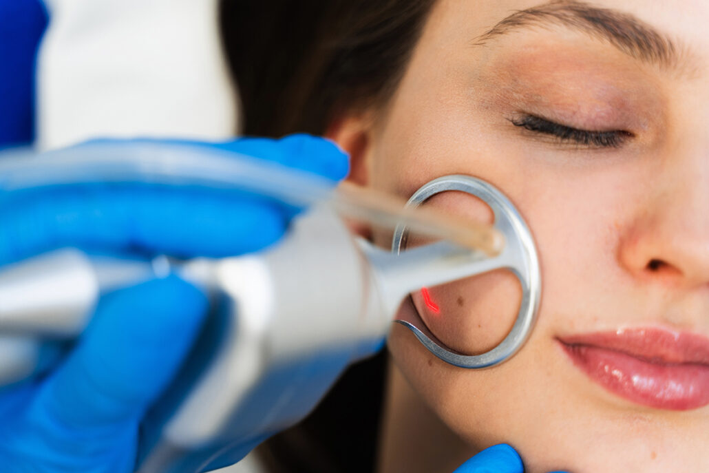 Close-up of laser resurfacing procedure targeting facial skin to improve texture, scars, and overall appearance