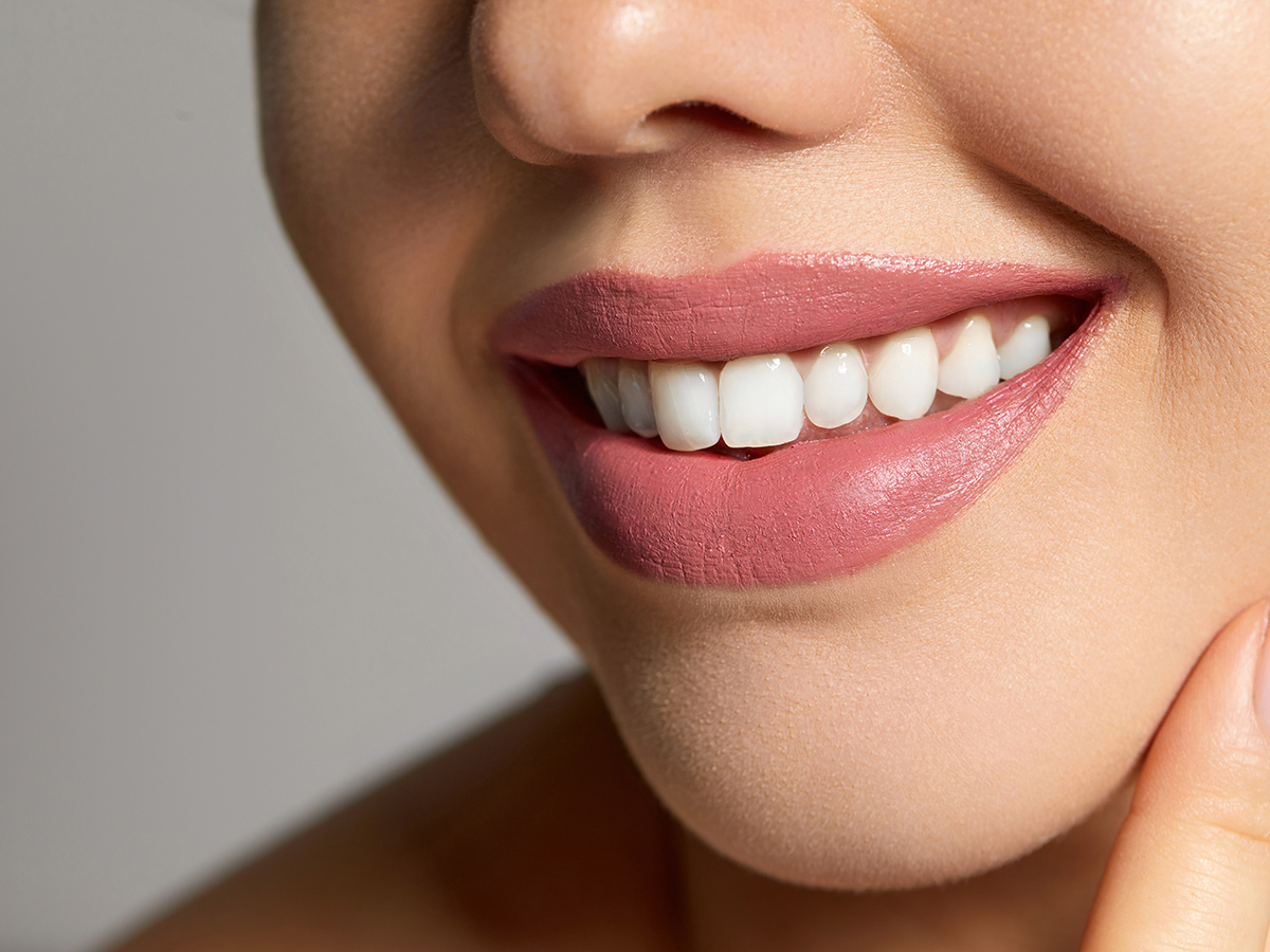 Close-up of smile with enhanced upper lip showing results of lip lift procedure and improved facial harmony