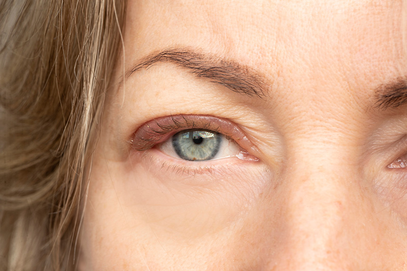 Close-up of lower eyelid showing reduced under-eye bags and smoother skin after lower blepharoplasty