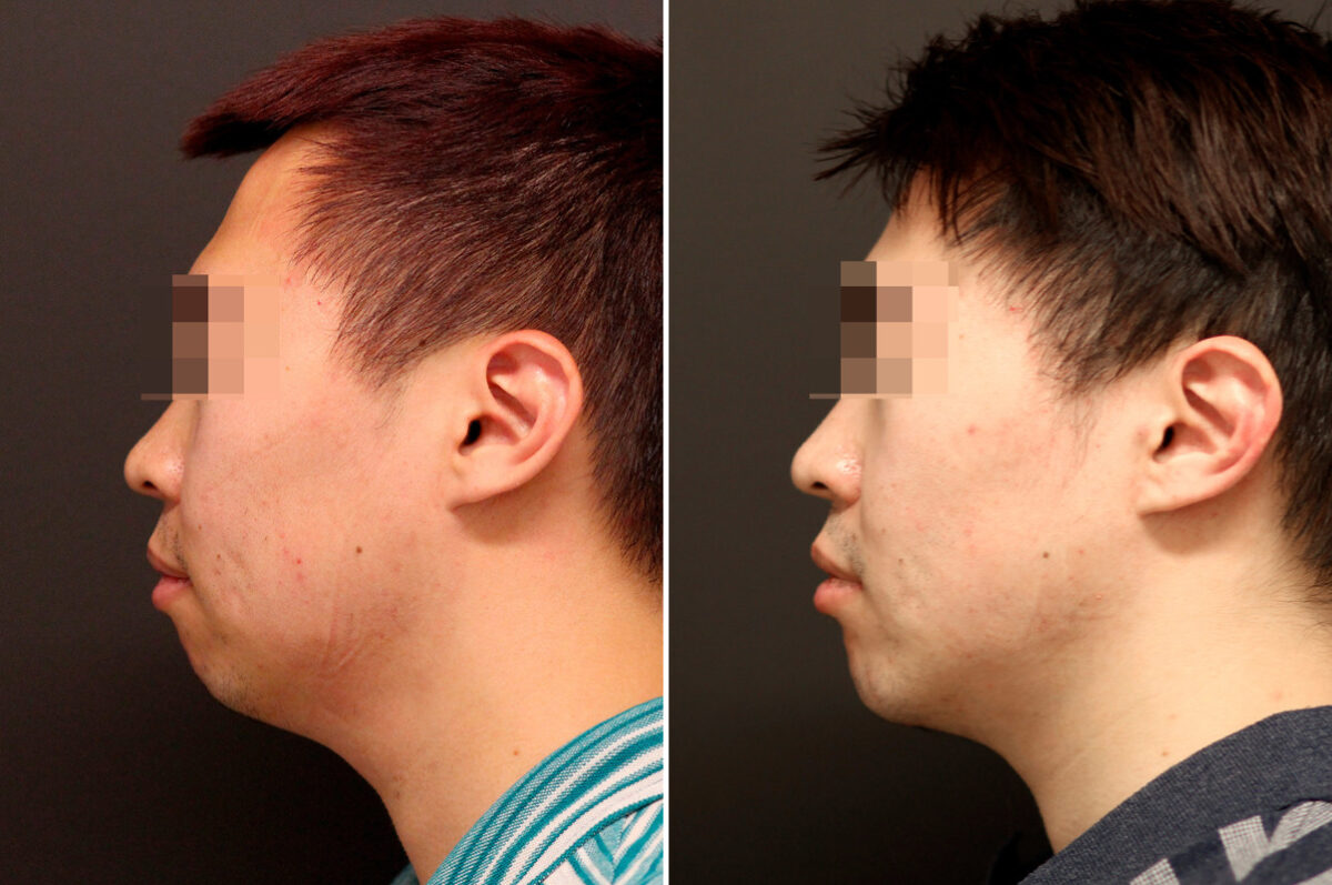 Chin Implants Before and After Photos in Princeton, NJ, Patient 10075