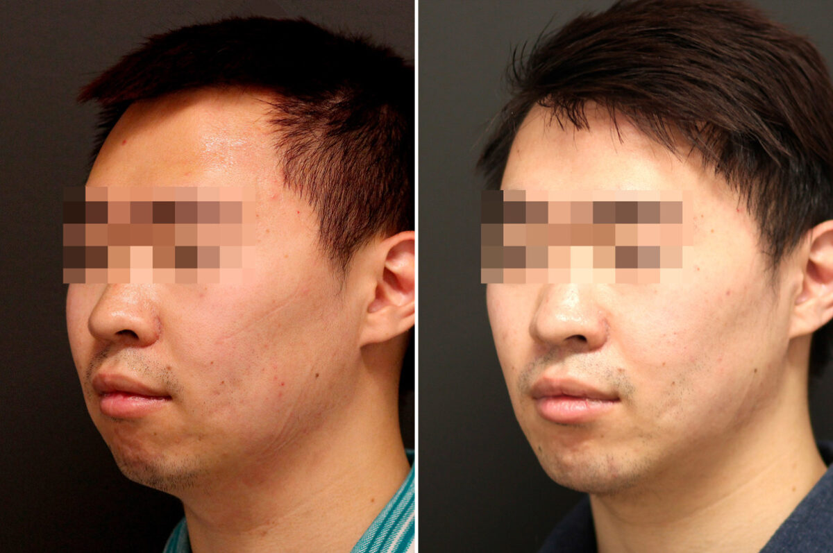 Chin Implants Before and After Photos in Princeton, NJ, Patient 10075