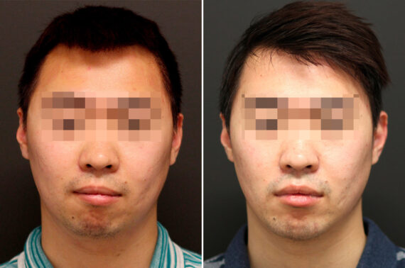 Chin Implants Before and After Photos in Princeton, NJ, Patient 10075