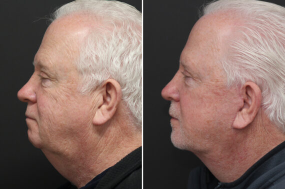 Facelift Before and After Photos in Princeton, NJ, Patient 10975