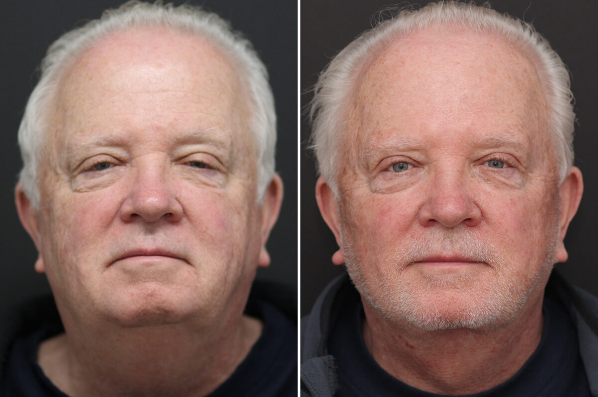 Facelift Before and After Photos in Princeton, NJ, Patient 10975