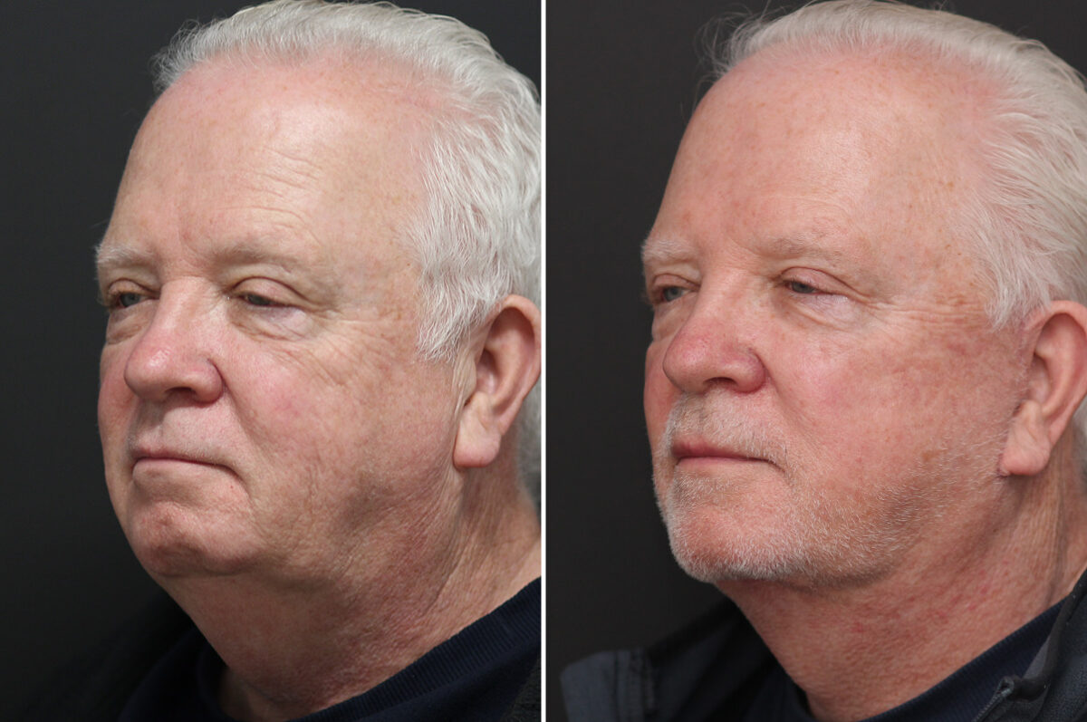 Facelift Before and After Photos in Princeton, NJ, Patient 10975