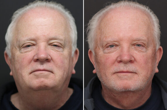 Facelift Before and After Photos in Princeton, NJ, Patient 10975