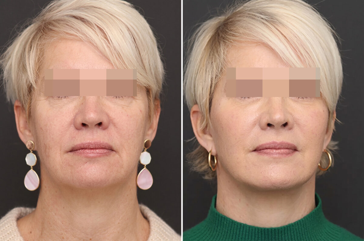 Facelift Before and After Photos in Princeton, NJ, Patient 11020