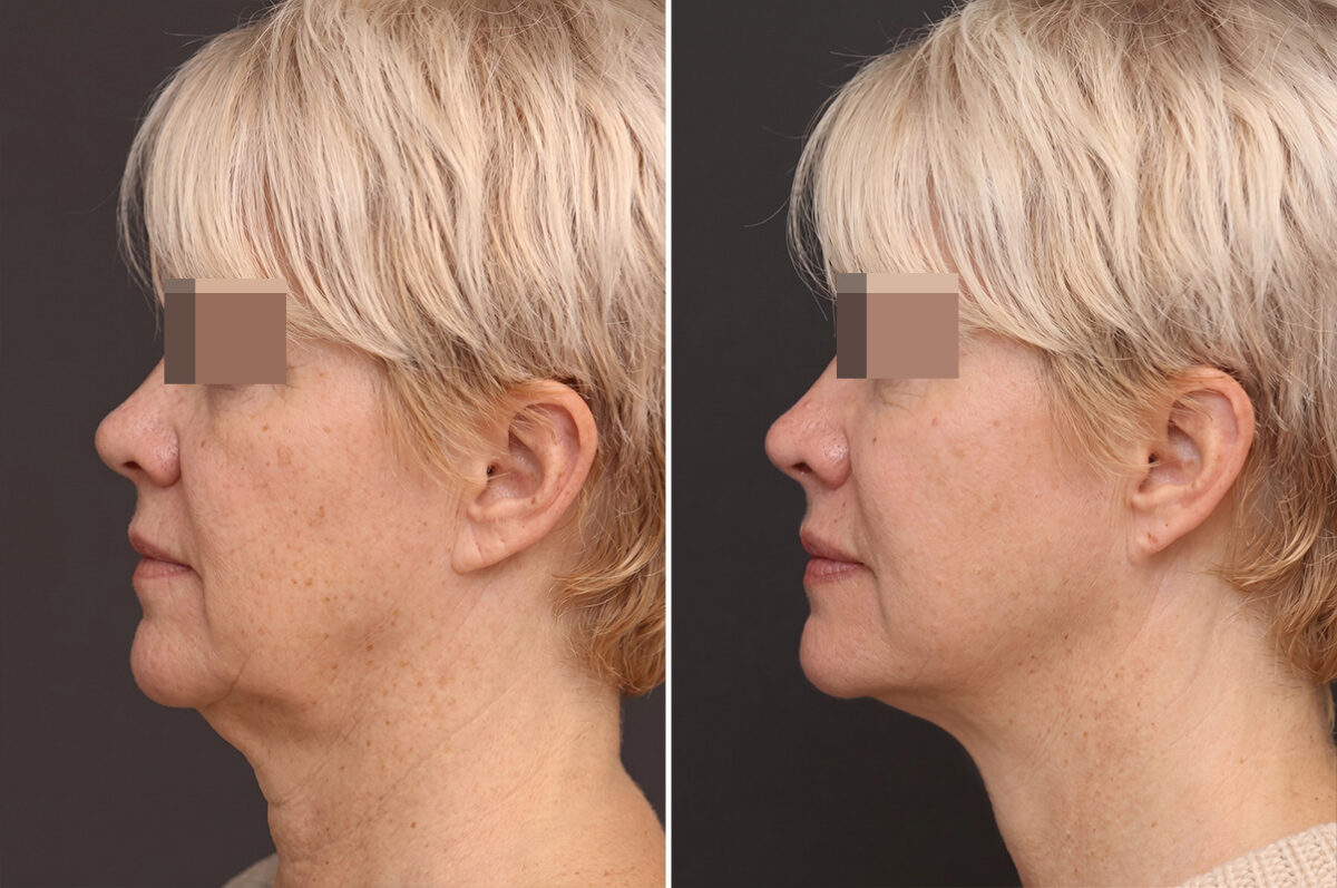 Facelift Before and After Photos in Princeton, NJ, Patient 11020