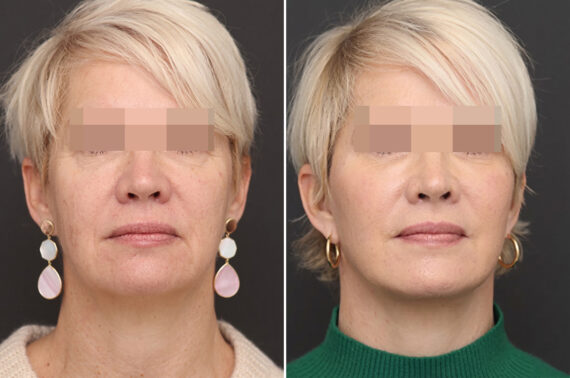 Facelift Before and After Photos in Princeton, NJ, Patient 11020