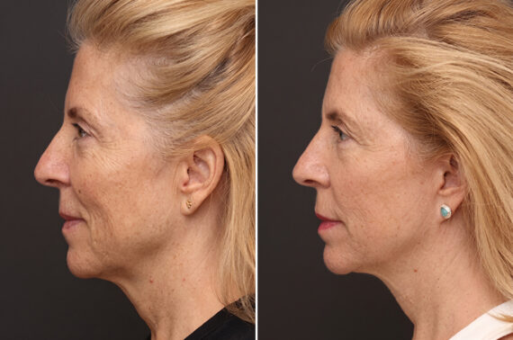 Facelift Before and After Photos in Princeton, NJ, Patient 11022
