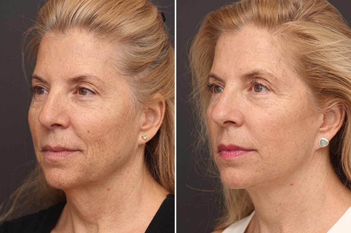 Facelift Before and After Photos in Princeton, NJ, Patient 11022