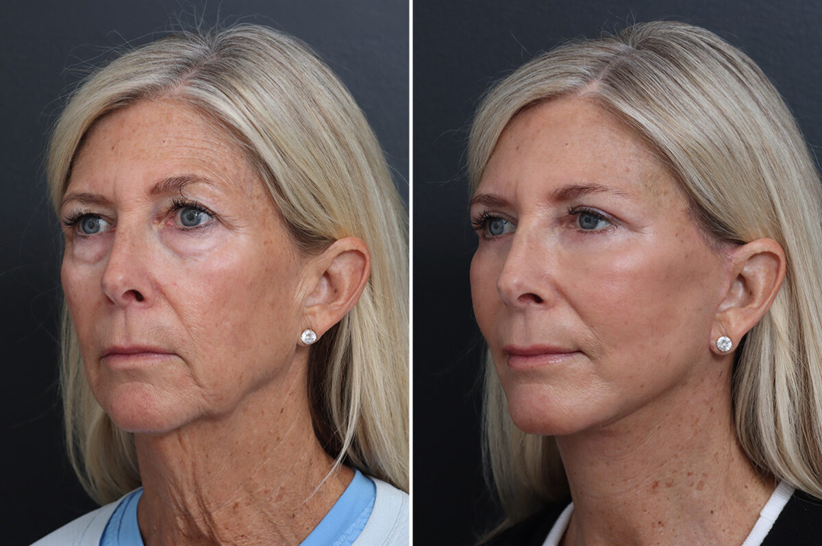 Facelift Before and After Photos in Princeton, NJ, Patient 17250
