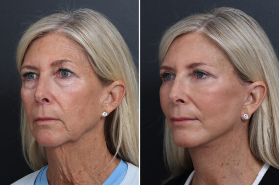 Facelift Before and After Photos in Princeton, NJ, Patient 17250