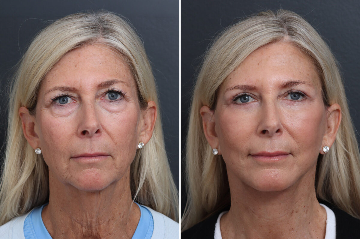 Facelift Before and After Photos in Princeton, NJ, Patient 17250