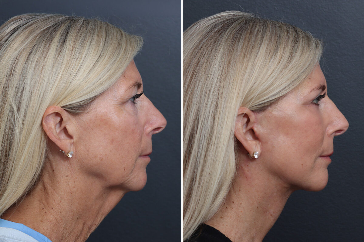 Facelift Before and After Photos in Princeton, NJ, Patient 17250