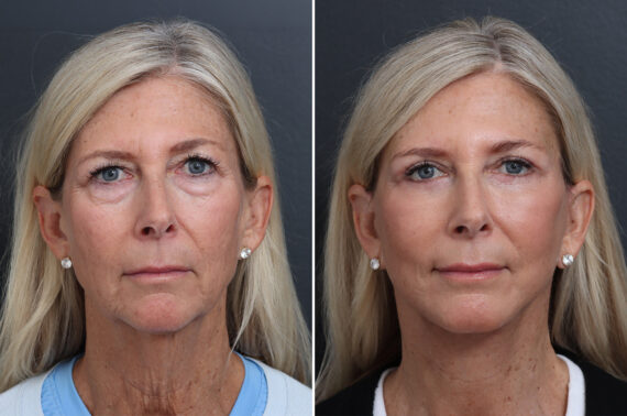 Facelift Before and After Photos in Princeton, NJ, Patient 17250