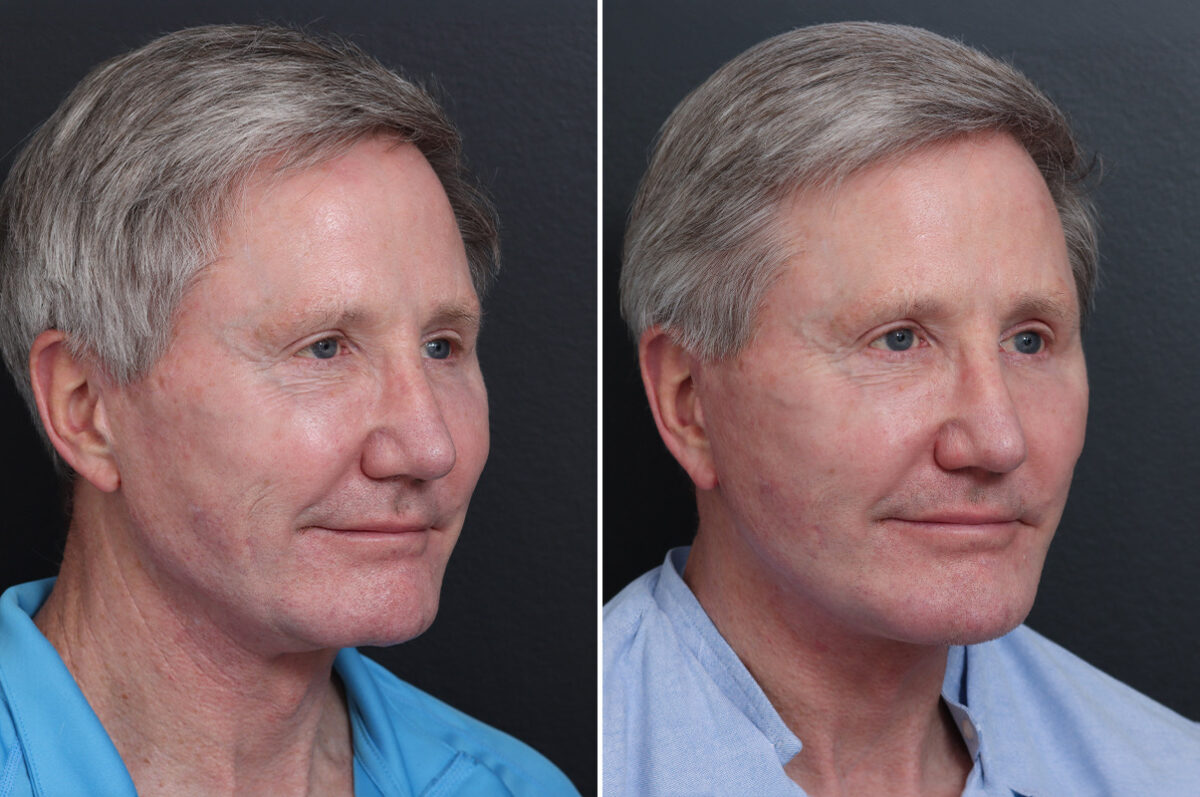 Facelift Before and After Photos in Princeton, NJ, Patient 17260