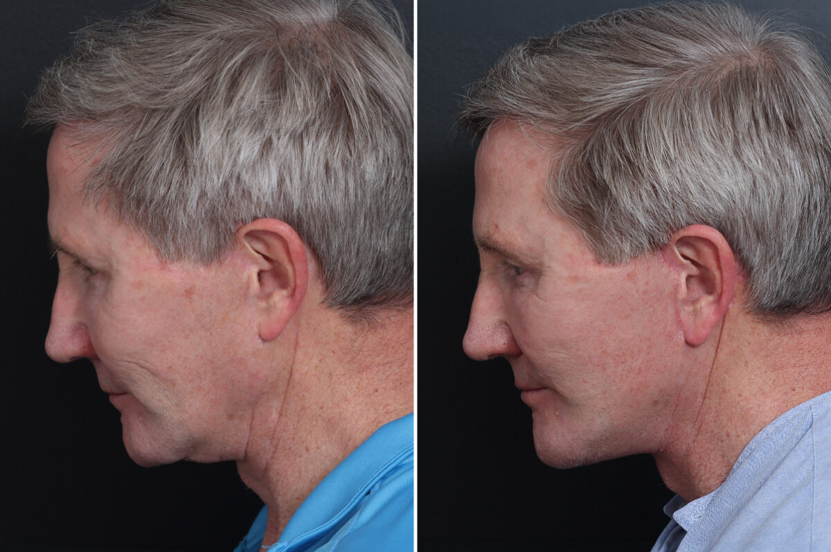 Facelift Before and After Photos in Princeton, NJ, Patient 17260