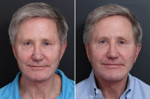 Facelift Before and After Photos in Princeton, NJ
