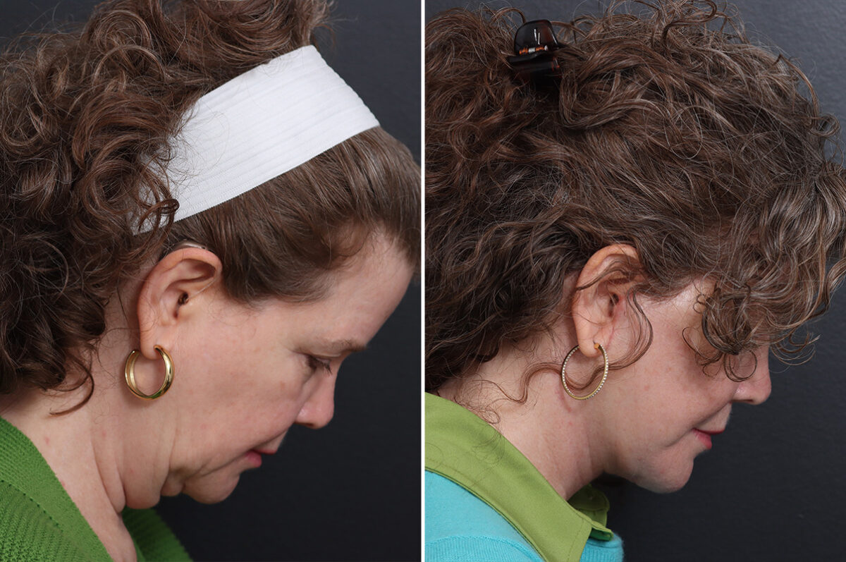 Facelift Before and After Photos in Princeton, NJ, Patient 17270